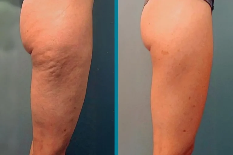profound-rf-cellulite-before-after-gallery-patient-18616347-image
